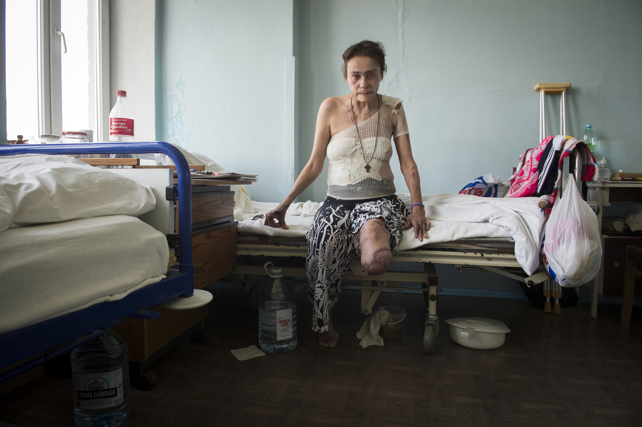 Kiev Hospital N°2.
Iryna Borisovna. 53 years old was injured by bomb the 14 th Feburary on Shasta city Lugansk region.
The fight between pro-Ukrainian troops and pro-Russian separatists is continuing in the Donbas region of eastern Ukraine despite the recent Minsk ceasefire agreements.